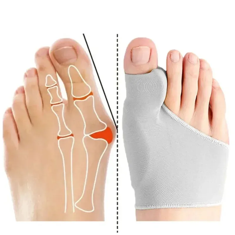 Hallux Valgus Bunion Corrector Orthesen Zehenspreizer – Fußknochen Daumenversteller Pediküre Sockenglätter für die Fußgesundheit