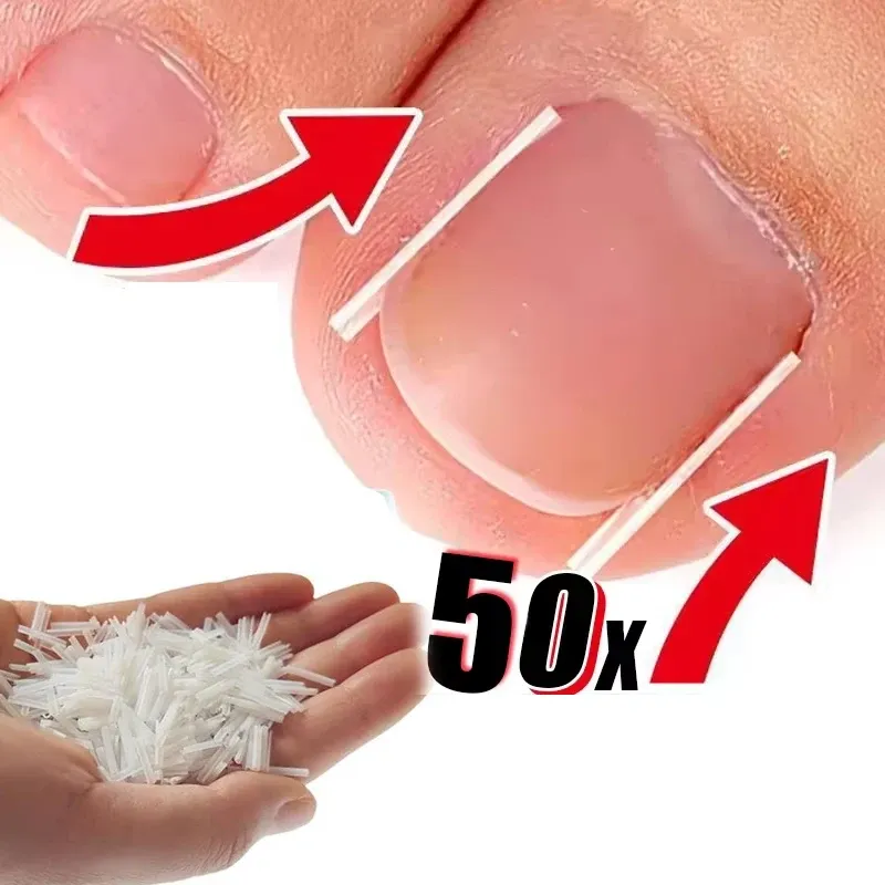 Korrekturwerkzeug für eingewachsene Zehennägel, Behandlung für eingewachsene Zehennägel, elastischer Patch, Aufkleber, Glättungsclip, Klammer, Pediküre-Werkzeug