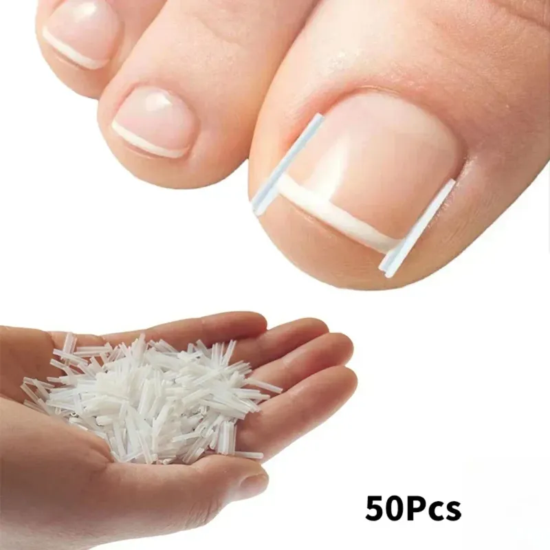 50Pcs Eingewachsene Zehennagel Korrektur Werkzeug Eingewachsene Zehennagel Behandlung Elastische Patch Aufkleber Richt Clip Klammer Pediküre Werkzeug