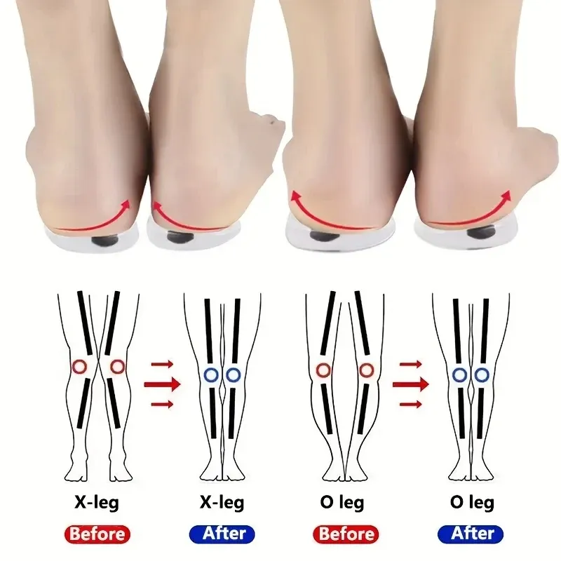 1 paar Orthopädische Einlegesohlen für Füße O/X Bein Typ Valgus Korrektur Männer Frauen Silikon Gel Schuhe Einlegesohle magnet Massage Schuh Pads